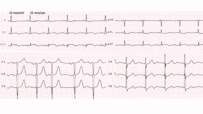Anterolateral Myocardial Infarction: Advanced ECG Patterns and Clinical Pearls