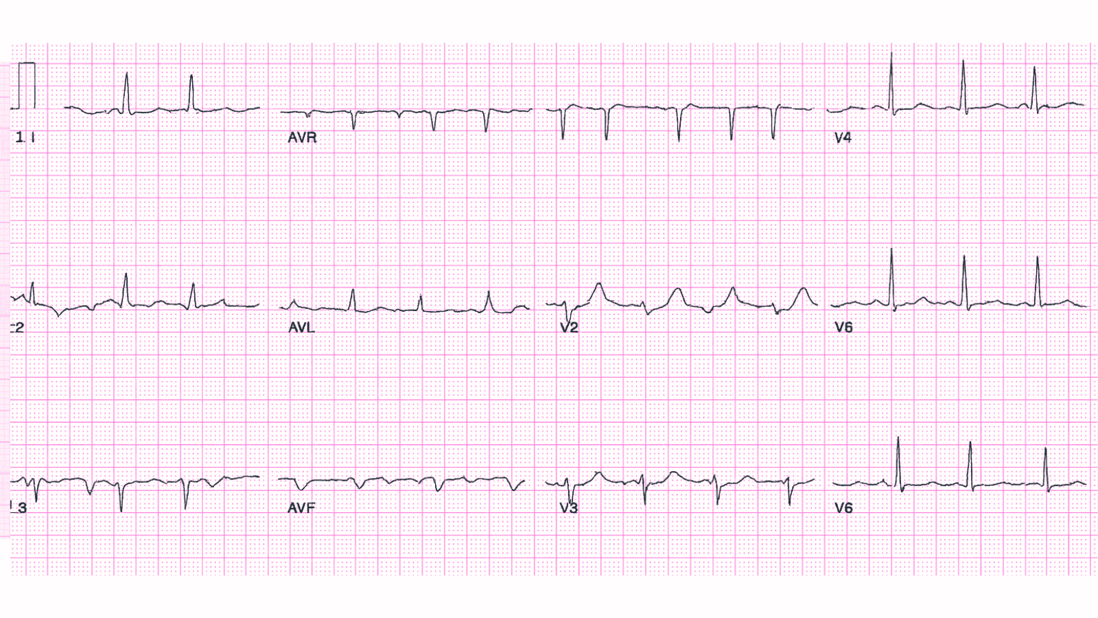 Anterior Wall Myocardial Infarction (AWMI): Advanced ECG Recognition and Emergency Management