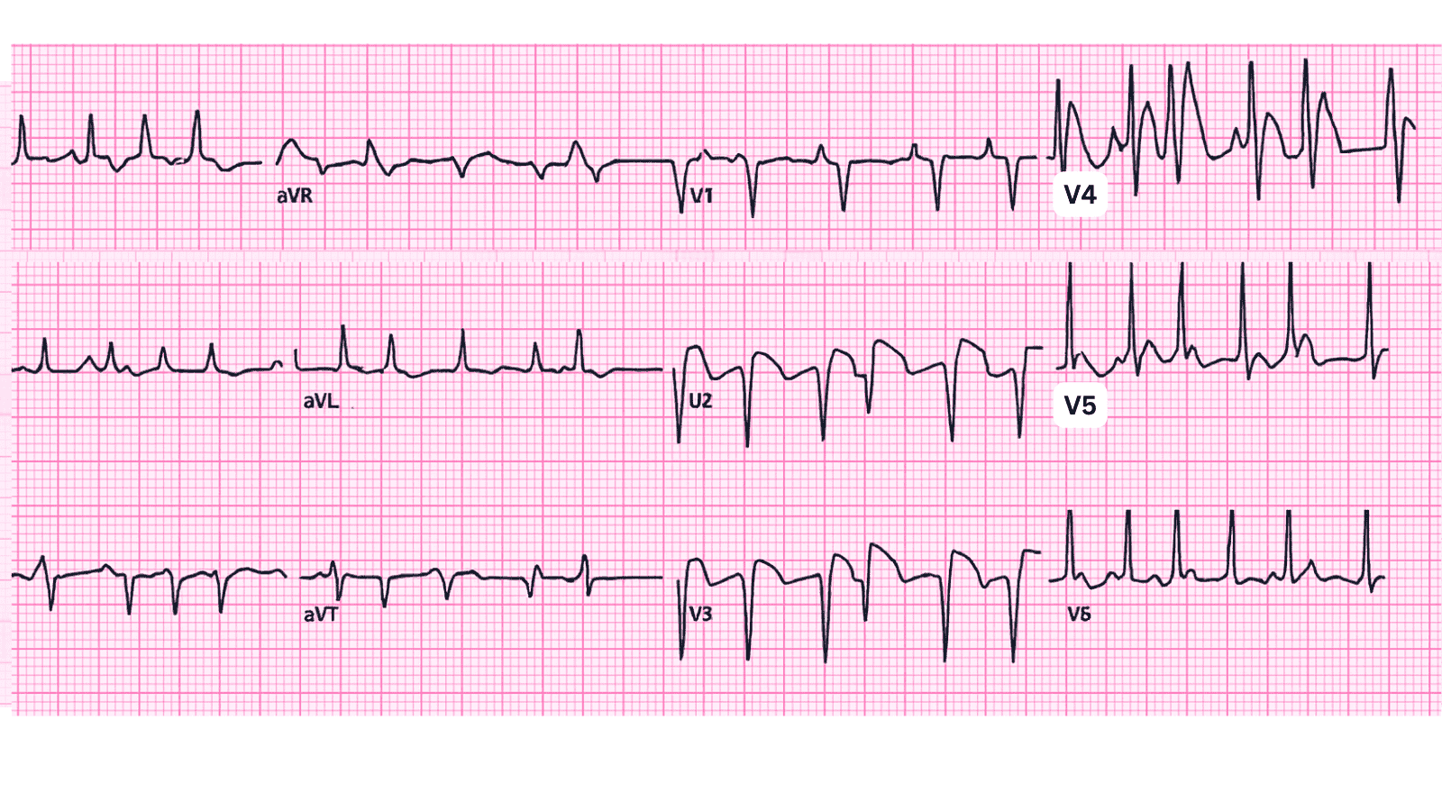 Atrial Fibrillation with Rapid Ventricular Response (RVR): Advanced ECG Recognition and Emergency Management