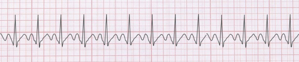 Normal Sinus Rhythm (NSR): The Foundation of ECG Interpretation