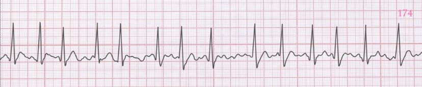 Atrial Fibrillation (AFib): Recognition and Clinical Significance
