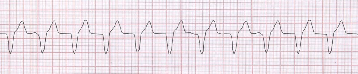 Accelerated Ventricular Rhythm: ECG Recognition and Clinical Management