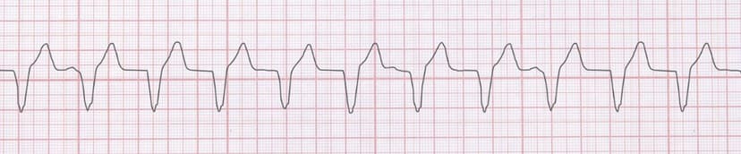 Accelerated Ventricular Rhythm: ECG Recognition and Clinical Management