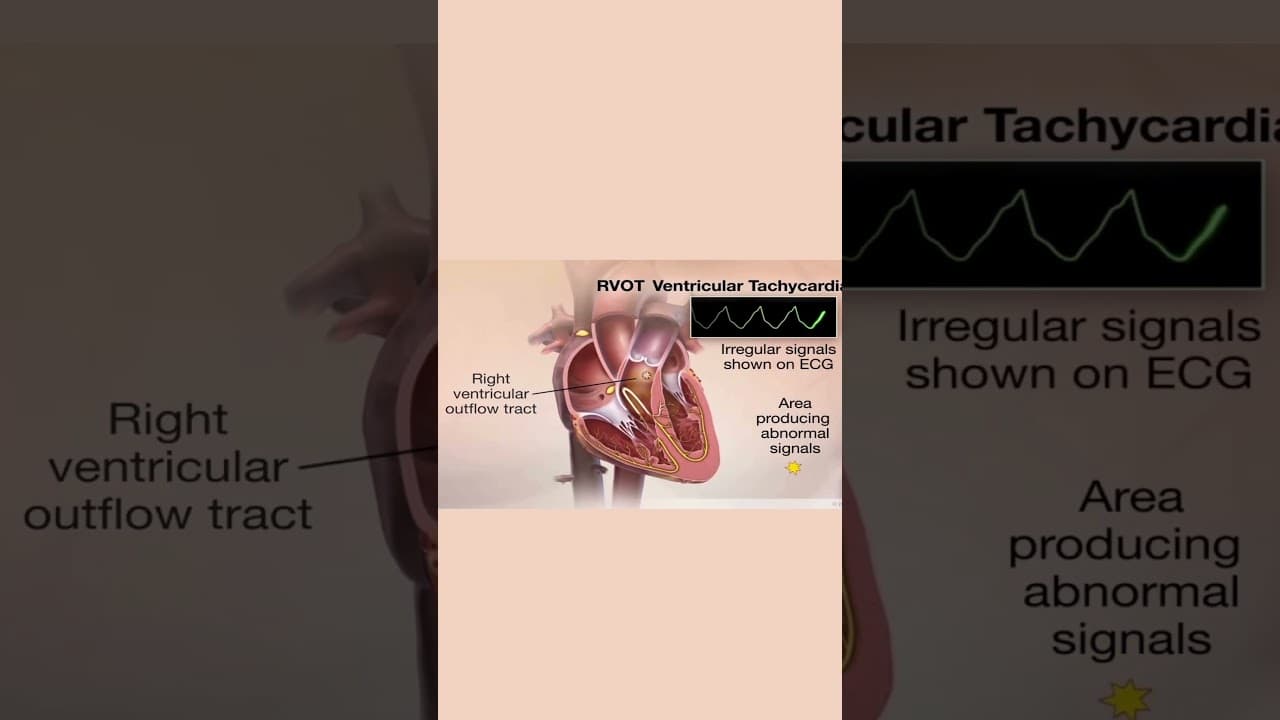 RVOT ventricular tachycardia #medicaleducation #nurse #ecg