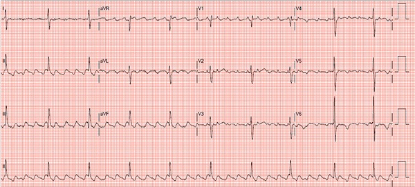 Atrial Flutter with 2:1 AV Conduction