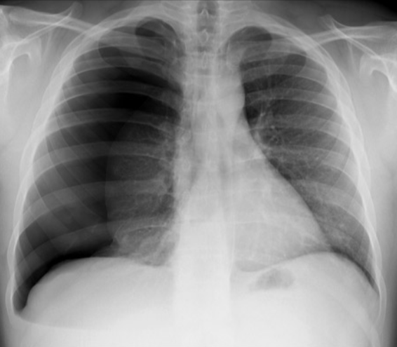 Original X-ray