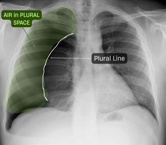 Right sided Pneumothorax labeled