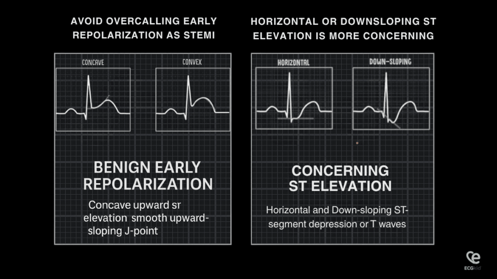 convex vs concave ST segments and horizontal and downsloping ST elevations