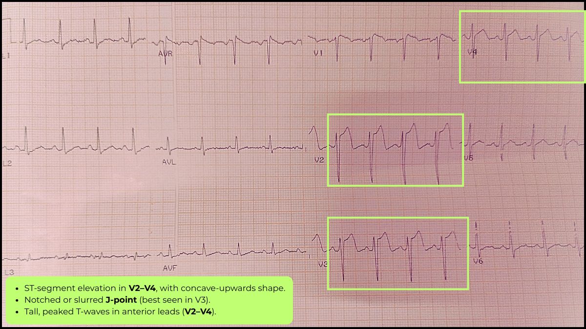 Annotated ECG showing early repolarization