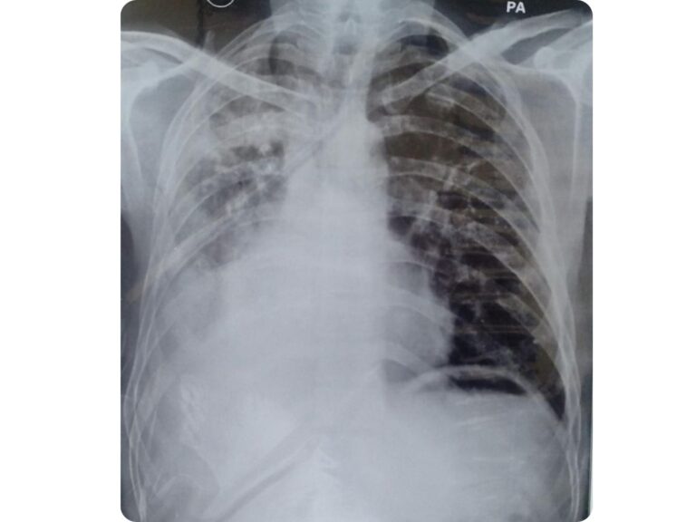 Extensive Right-sided Consolidation with Mediastinal Shift x-ray