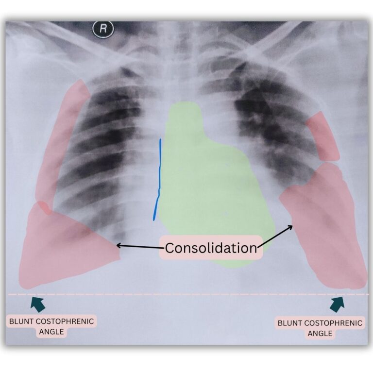 Pulmonary Edema on chest X-ray