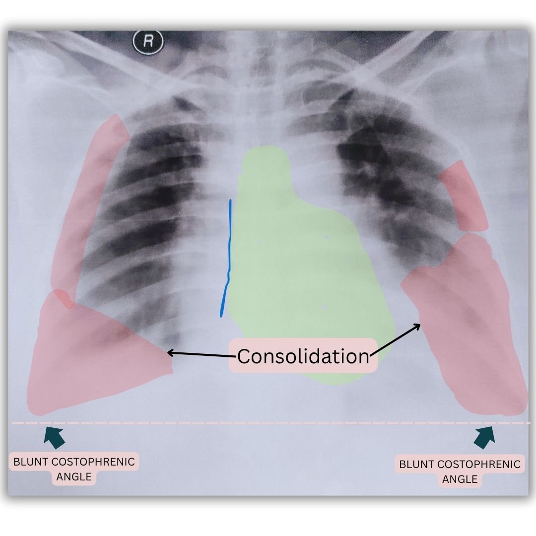 Annotated X-ray