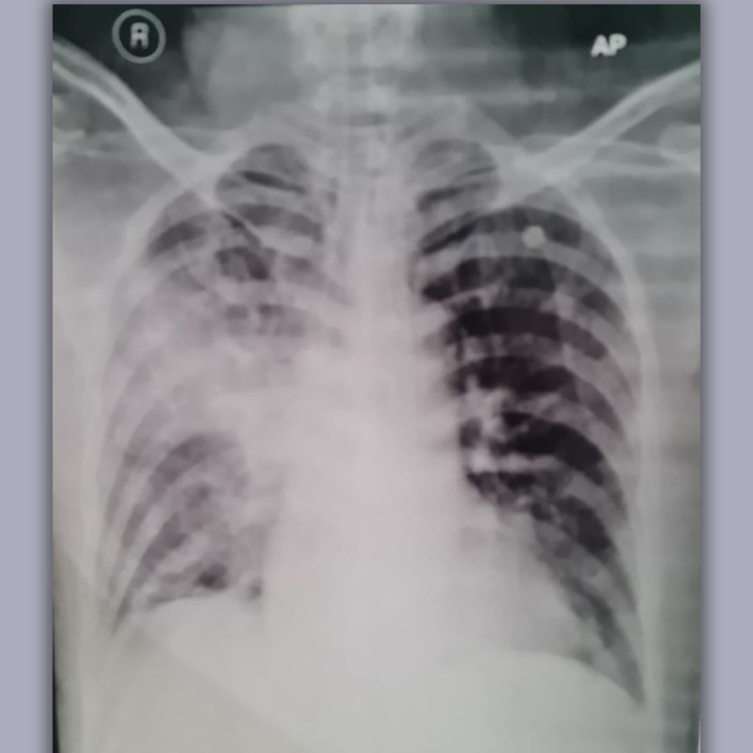 Original X-ray