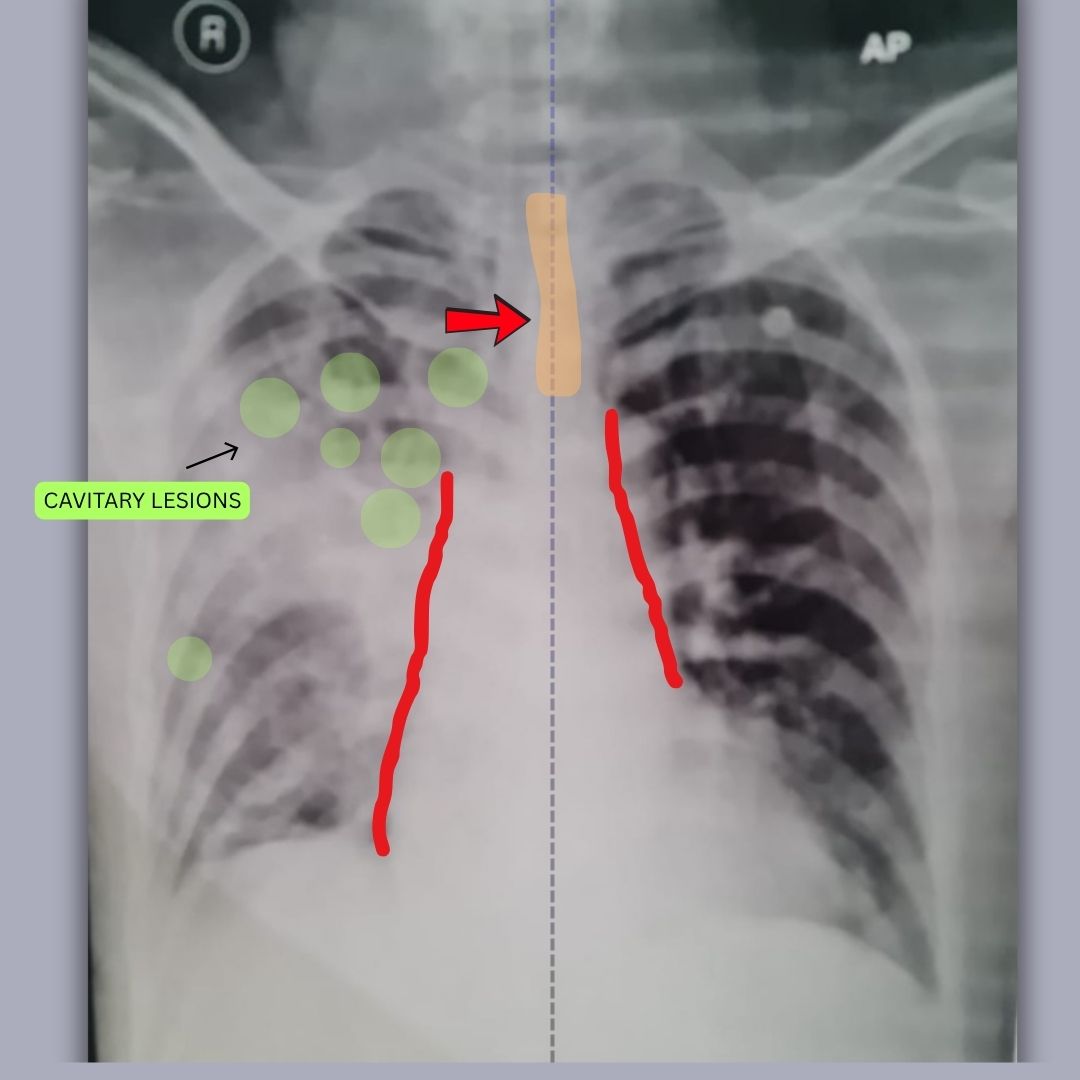 Annotated X-ray