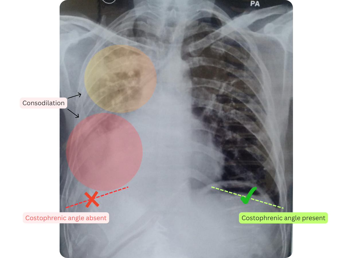 Annotated X-ray