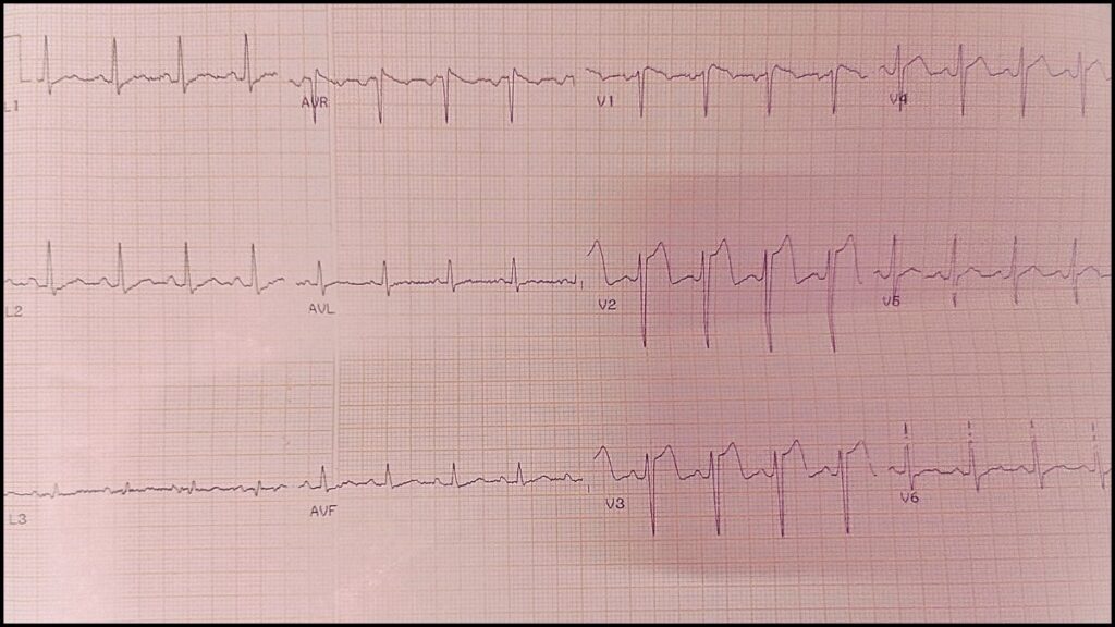 Early repolarization pattern ECG