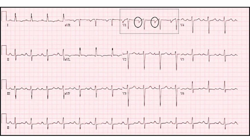 12-lead ECG segment from lead V1 highlighting a deep, terminal negative P wave deflection used to calculate P-wave terminal force (PTFV₁), an early marker for atrial fibrillation and atrial cardiomyopathy.