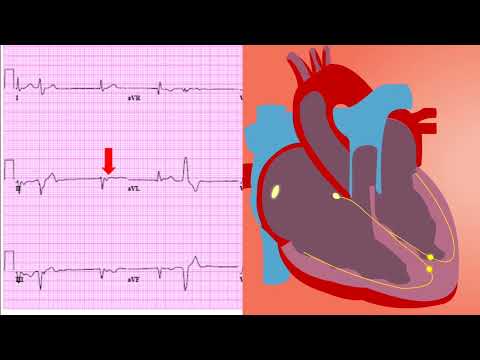 #Junctional Rhythm on ECG – Types and criterias to Diagnose it